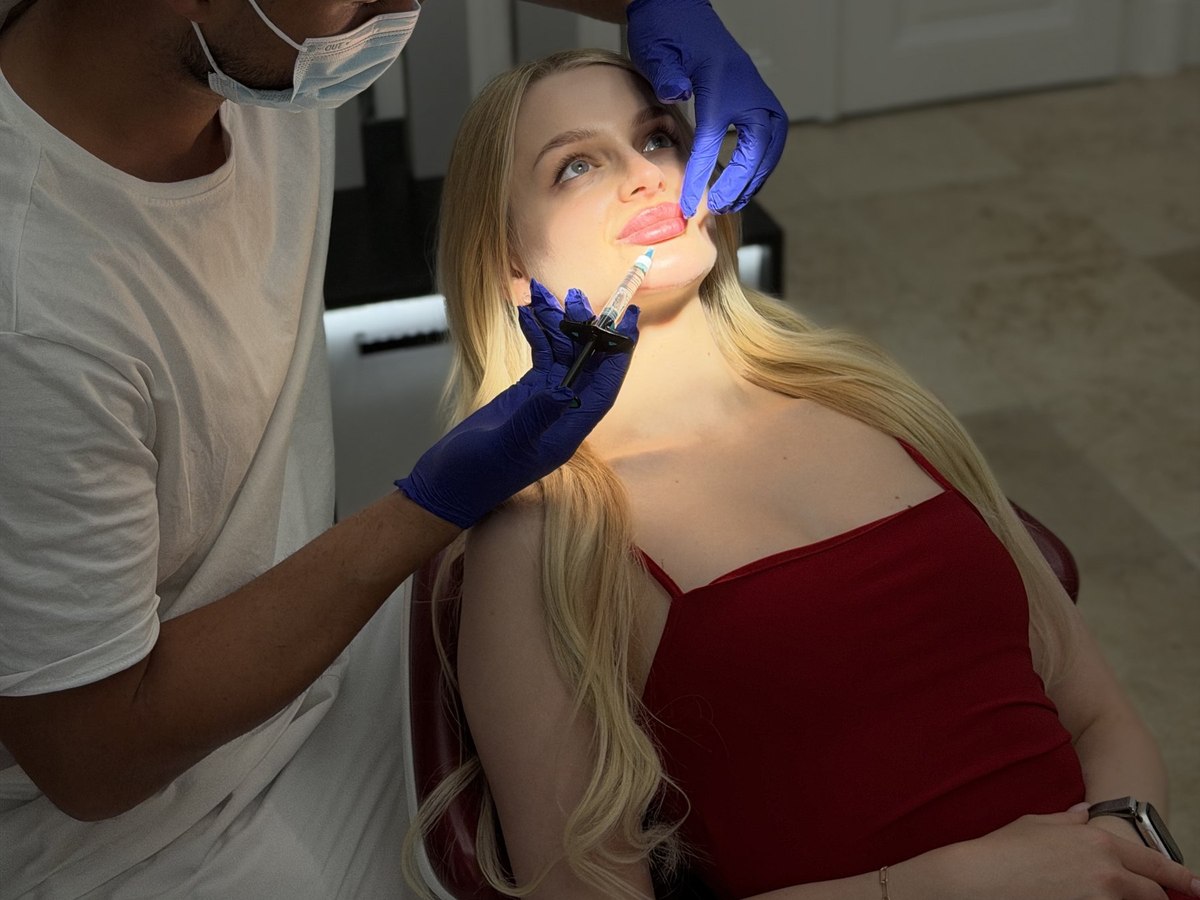 Aplikace výplně do rtů v ordinaci Fresh Vibes Beauty, Praha 1
