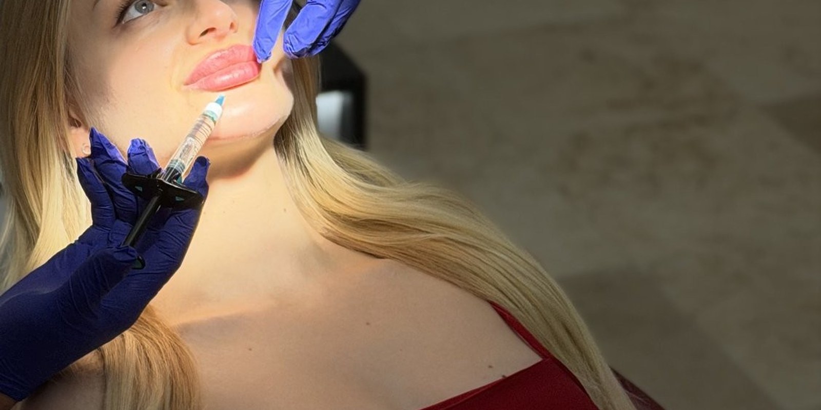 Aplikace hyaluronové výplně do rtů ve Fresh Vibes Beauty, Praha 1