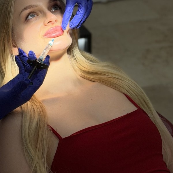 Zvětšení rtů ve Fresh Vibes Beauty — ošetření v ordinaci, Praha 1